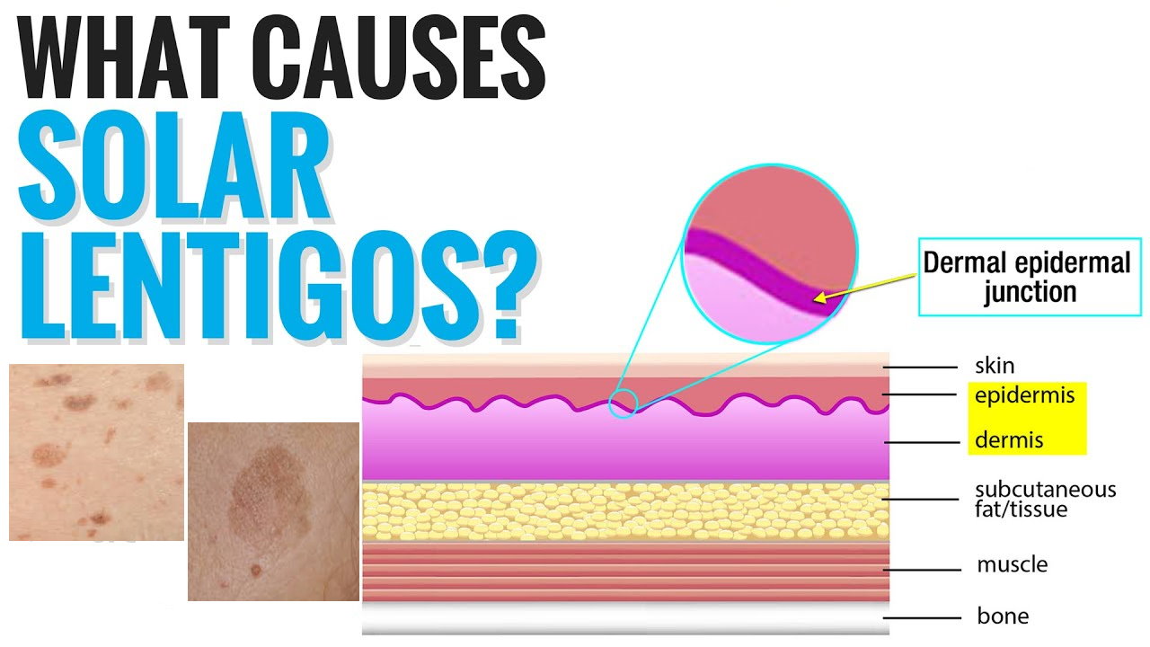 孚美达“氟轻松氢醌维A酸乳膏”能用于老年斑治疗吗？