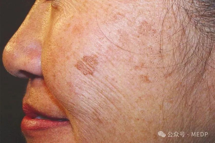 老年斑、晒斑、日光性雀斑是一回事吗？